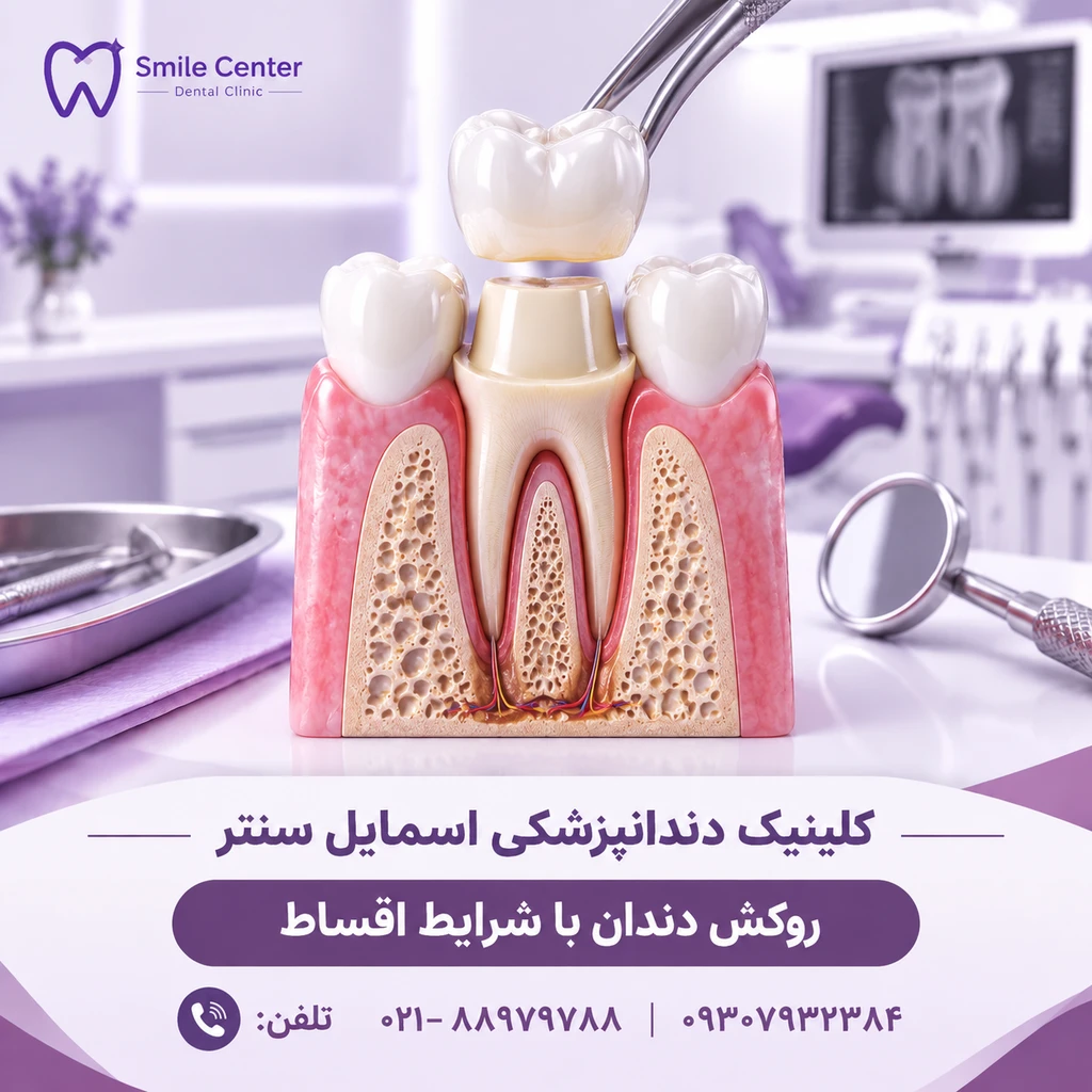قیمت روکش دندان